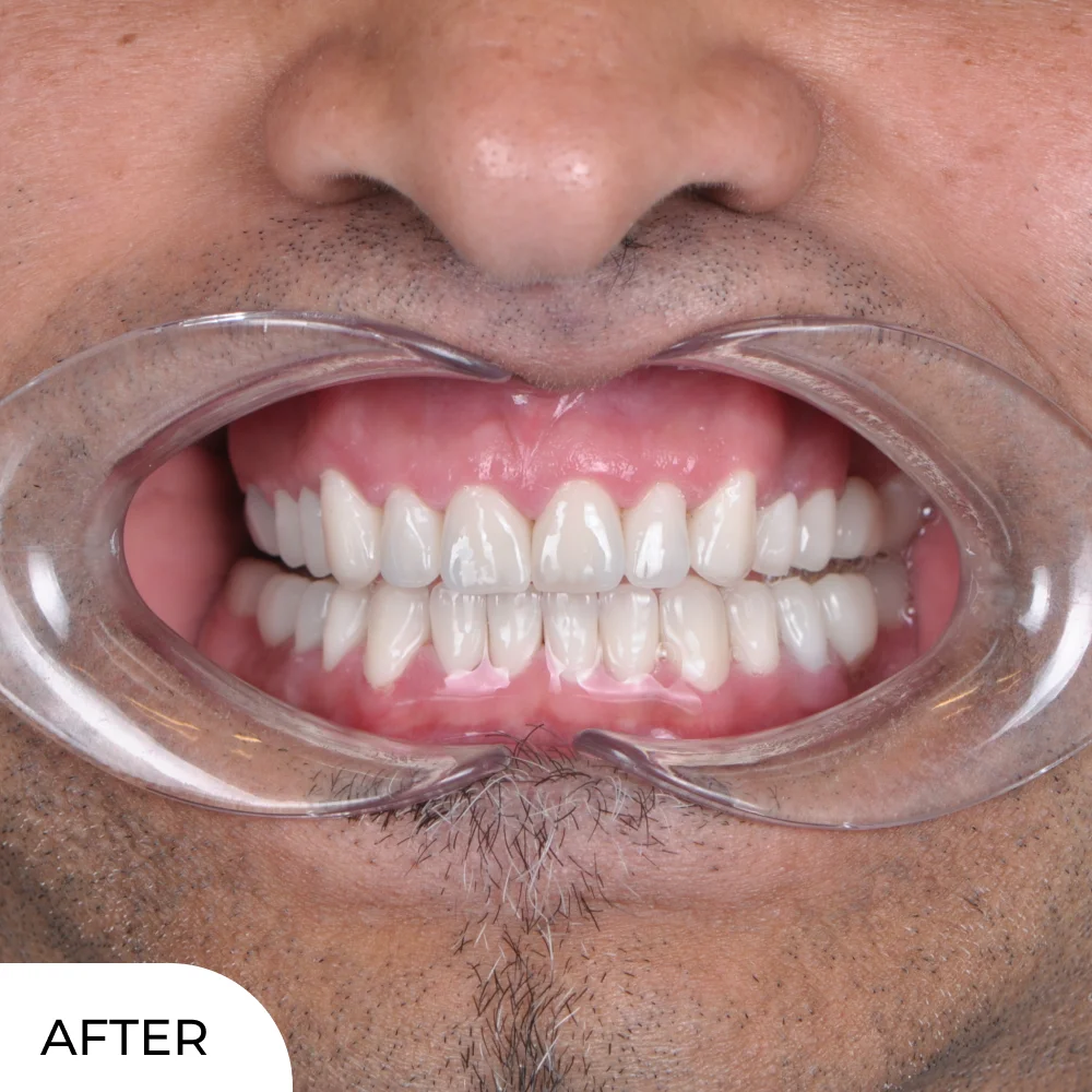 Dejan closeup after aqua dental clinic