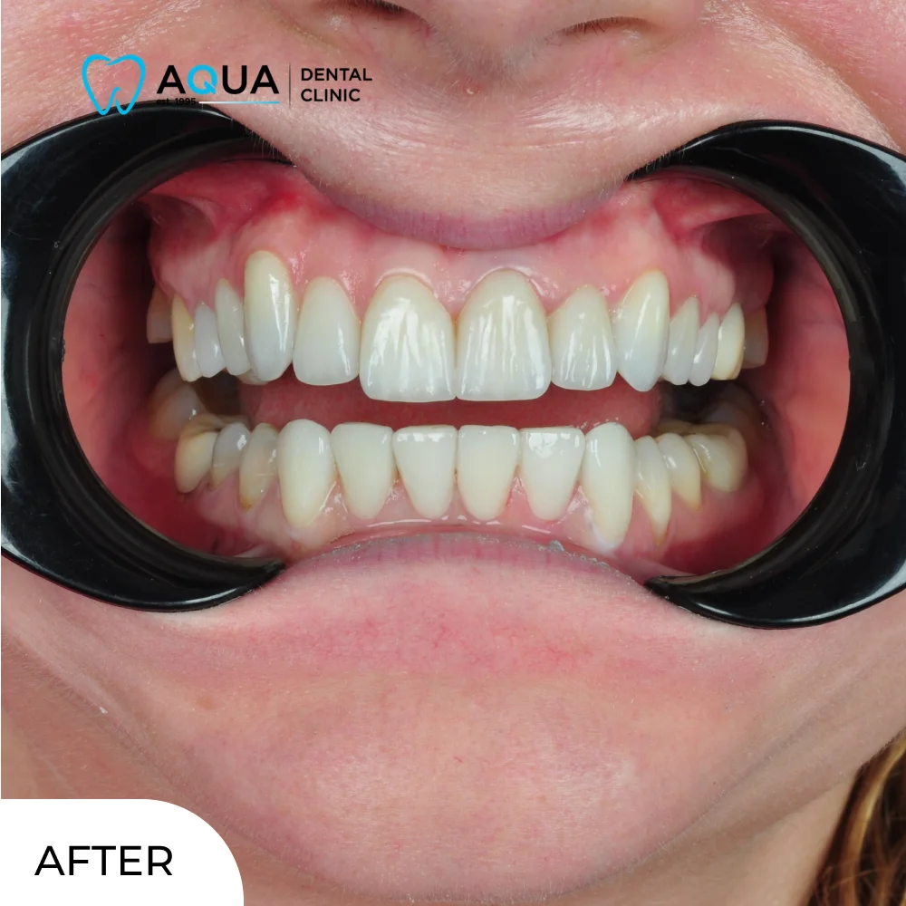 ayse-tig-aqua-dental-clinic-after-closeup