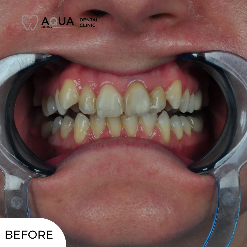 ayse-tig-aqua-dental-clinic-before-closeup