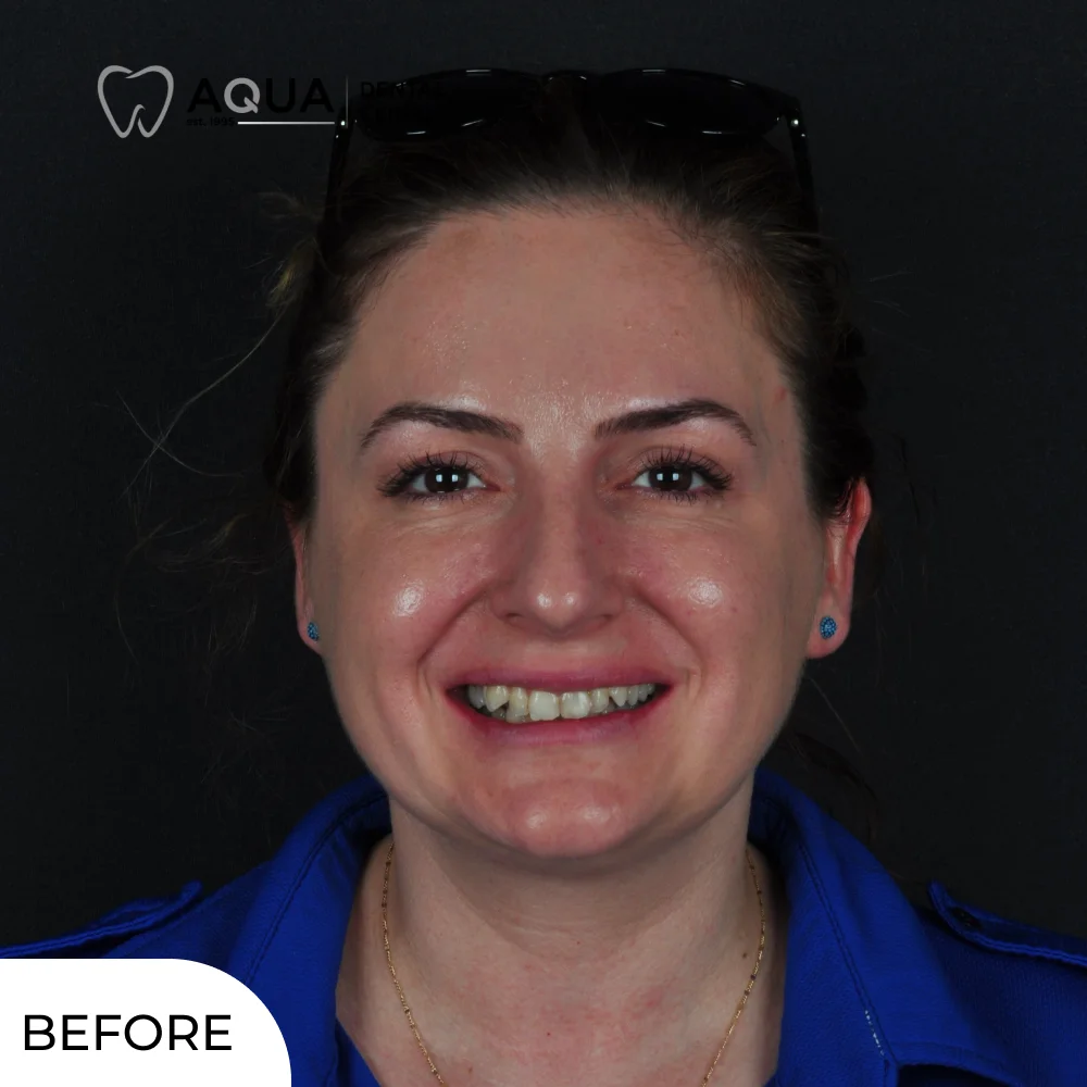 ayse-tig-aqua-dental-clinic-before-face
