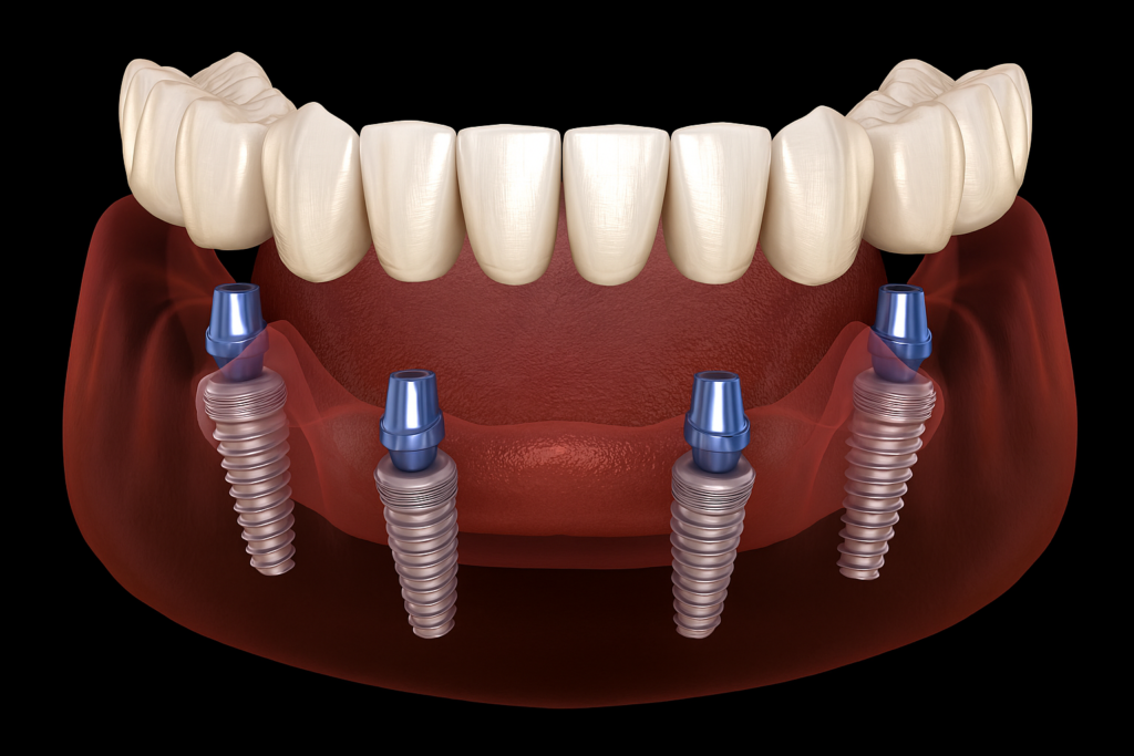 3D illustration of All-on-4 dental implants showing angled and straight implant placement in the lower jaw